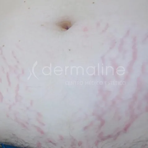 tratamiento-estrias-1-antes