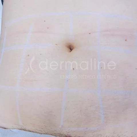 tratamiento-estrias-1-despues