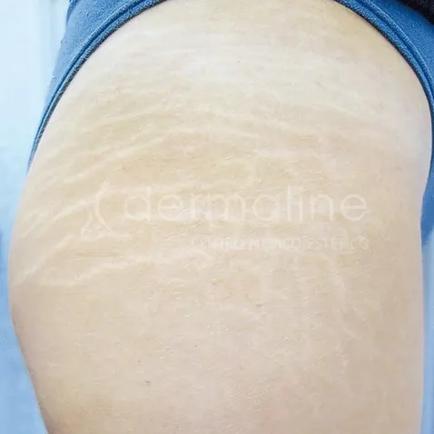 tratamiento-estrias-3-antes